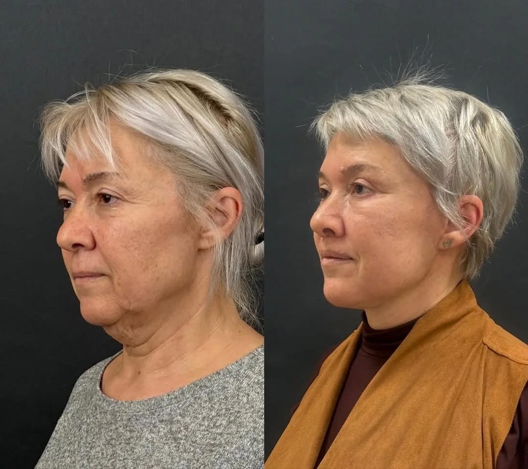 Before and after deep plane facelift — 58-year-old woman, oblique left view, 6mo post-op by Dr. Mehmet Akbalık