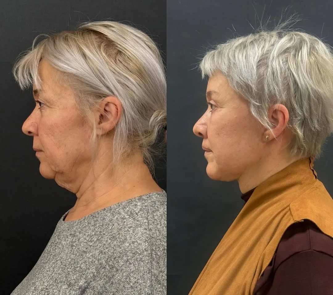 Before and after deep plane facelift — 62-year-old woman, left profile view, 6mo post-op by Dr. Mehmet Akbalık