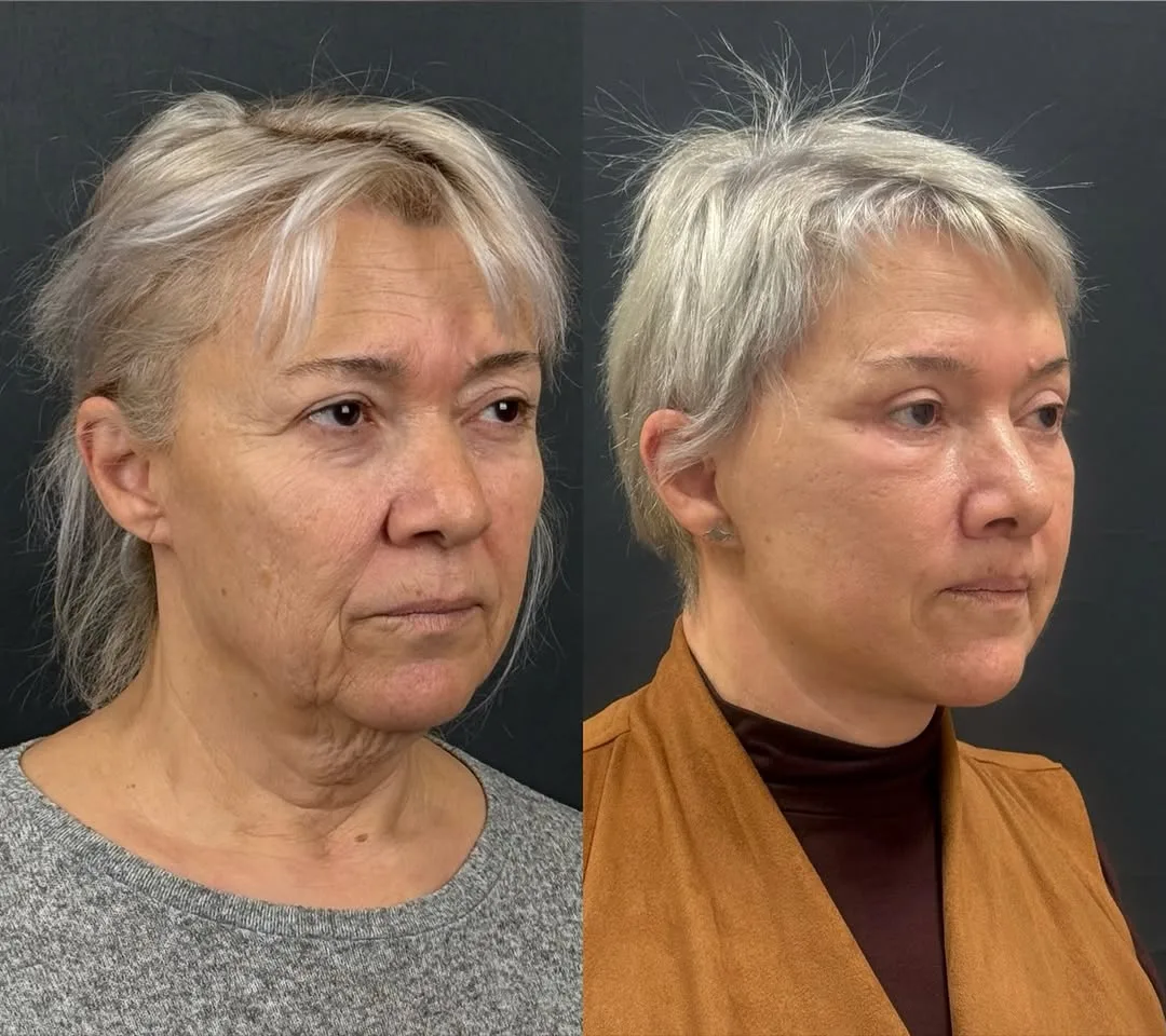 Before and after deep plane facelift — 62-year-old woman, oblique right view, 6mo post-op by Dr. Mehmet Akbalık