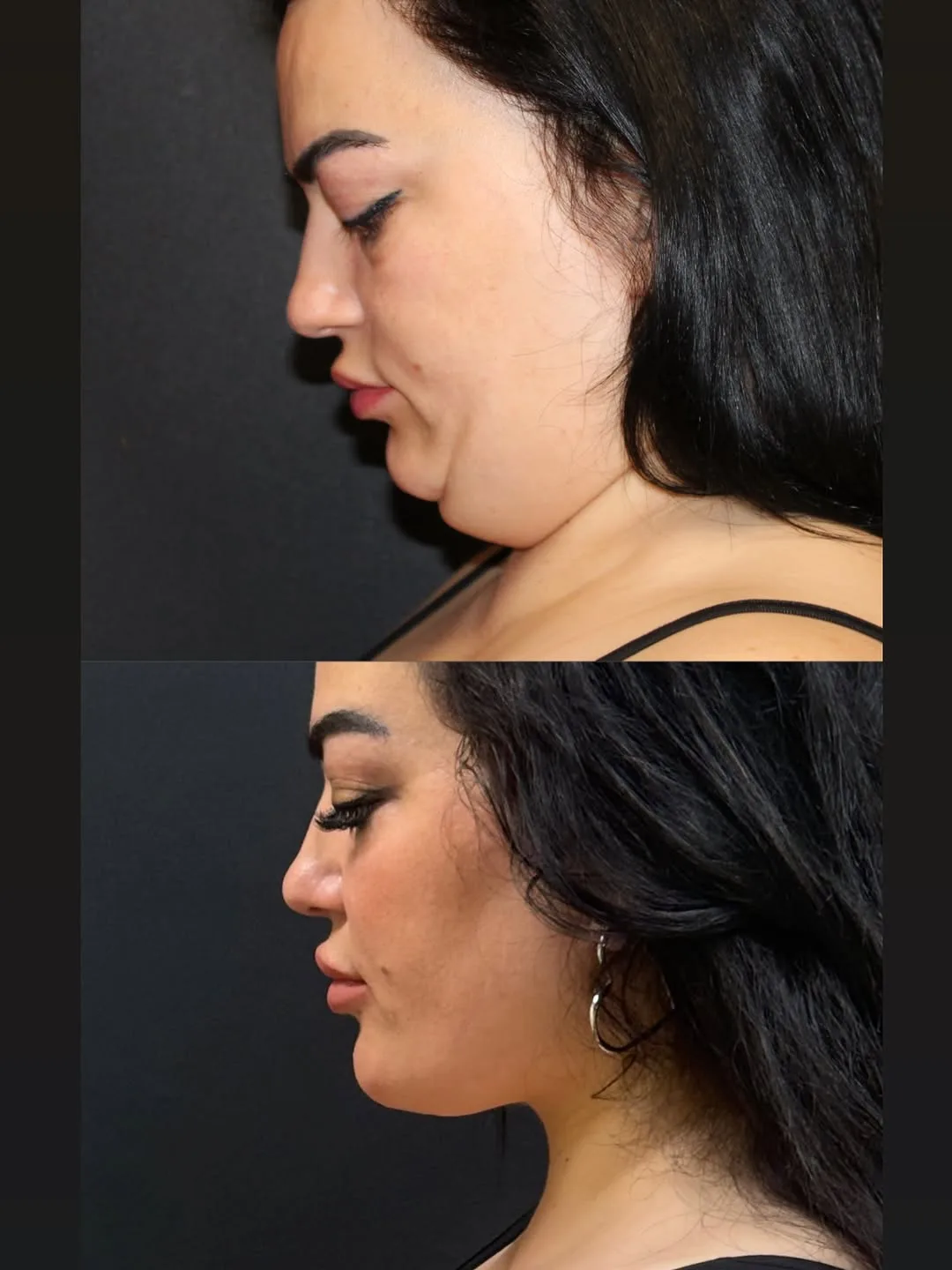 Before and after deep plane facelift — 28-year-old woman, left profile view, 12mo post-op by Dr. Mehmet Akbalık