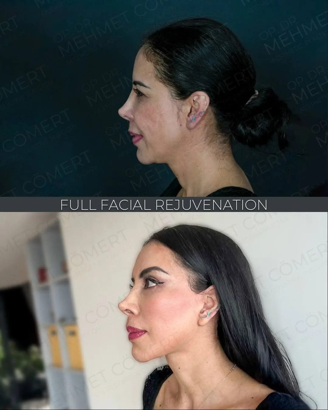 Before and after deep plane facelift — 32-year-old woman, left profile view, 9mo post-op by Dr. Mehmet Cömert