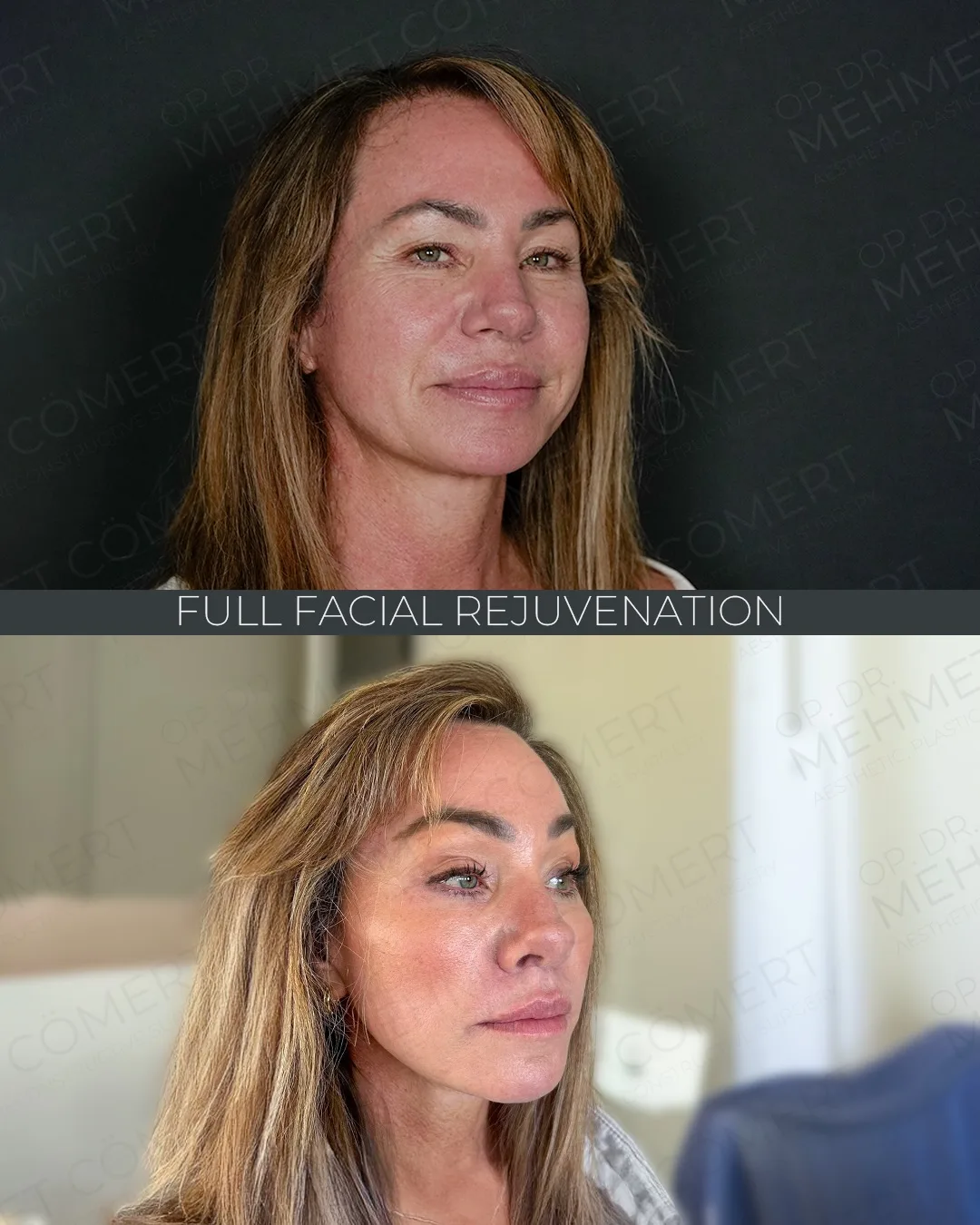 Before and after deep plane facelift — 48-year-old woman, three-quarter view, 4mo post-op by Dr. Mehmet Cömert