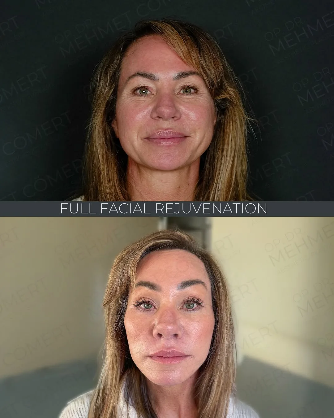 Before and after deep plane facelift — 48-year-old woman, frontal view, 7mo post-op by Dr. Mehmet Cömert