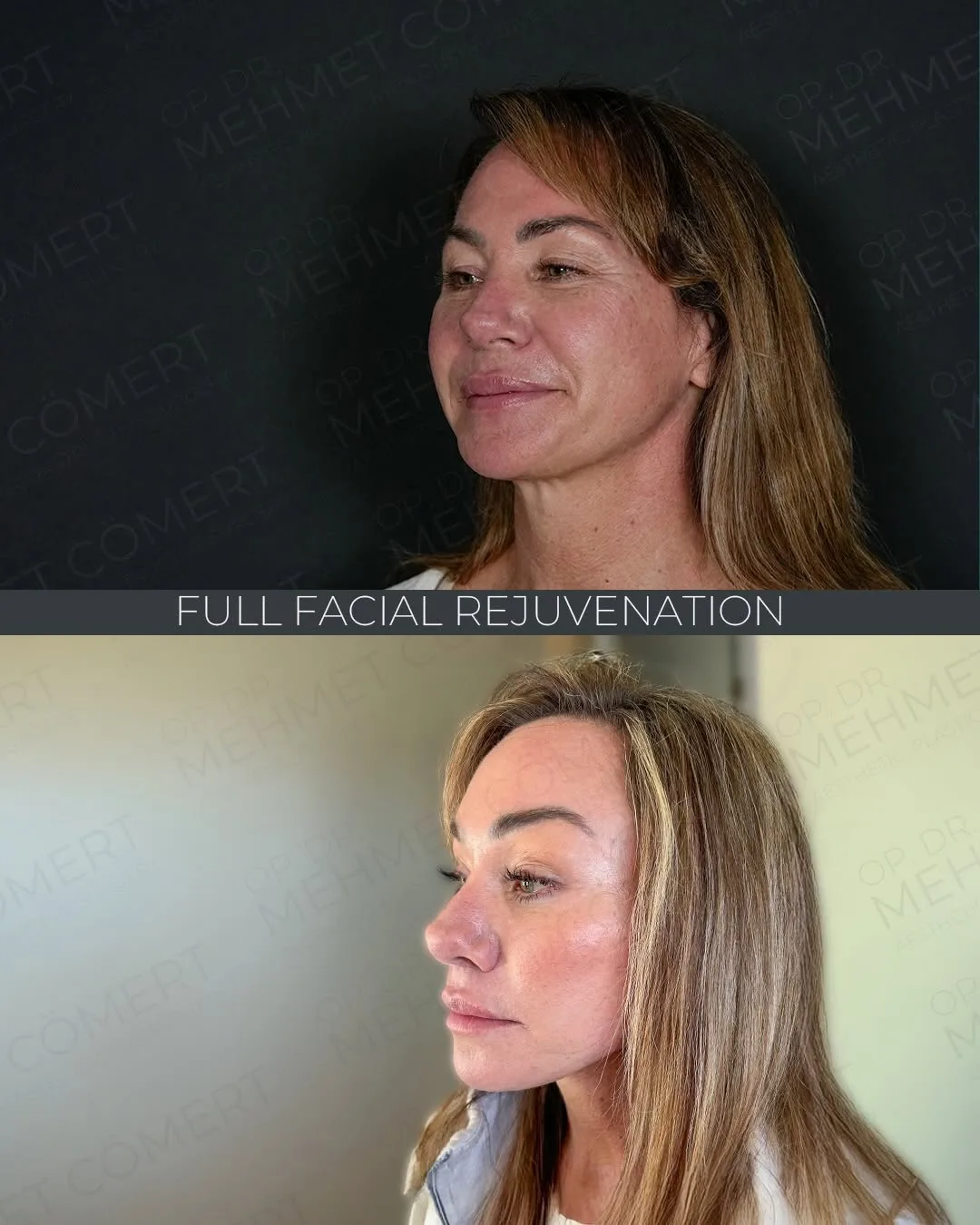 Before and after deep plane facelift — 45-year-old woman, three-quarter view, 6mo post-op by Dr. Mehmet Cömert