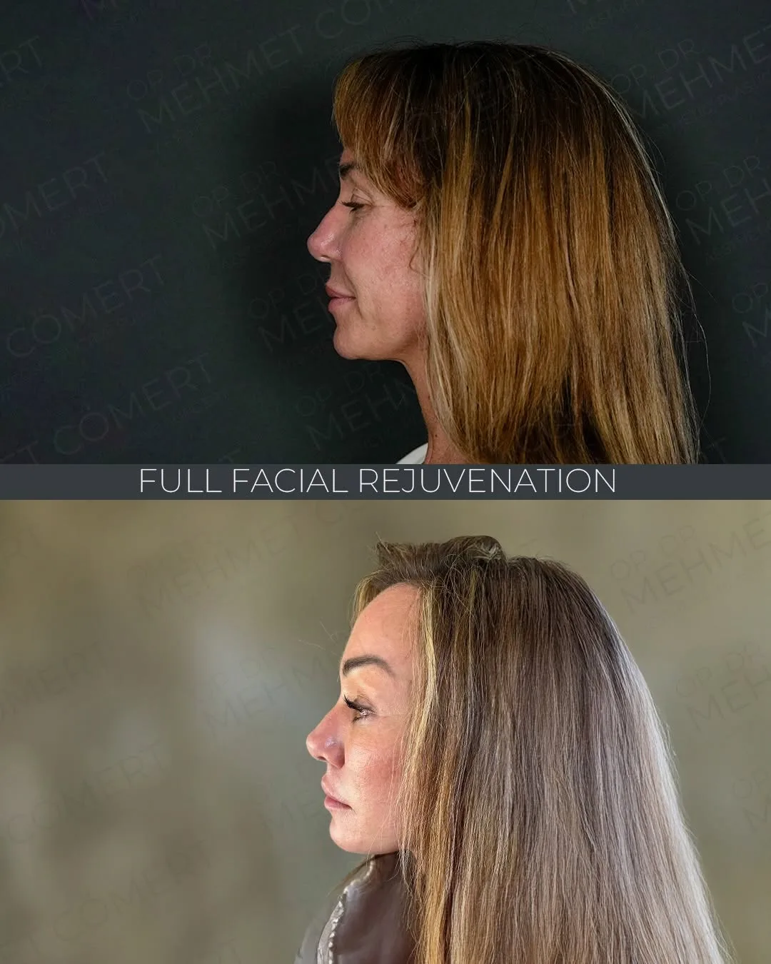 Before and after deep plane facelift — 45-year-old woman, left profile view, 9mo post-op by Dr. Mehmet Cömert