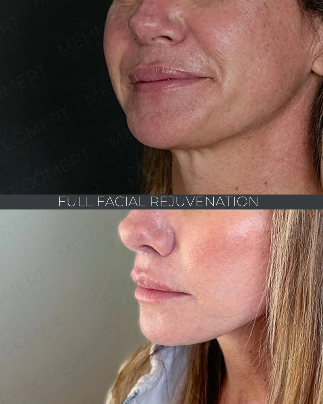 Before and after deep plane facelift — 45-year-old woman, right profile view, 6mo post-op by Dr. Mehmet Cömert