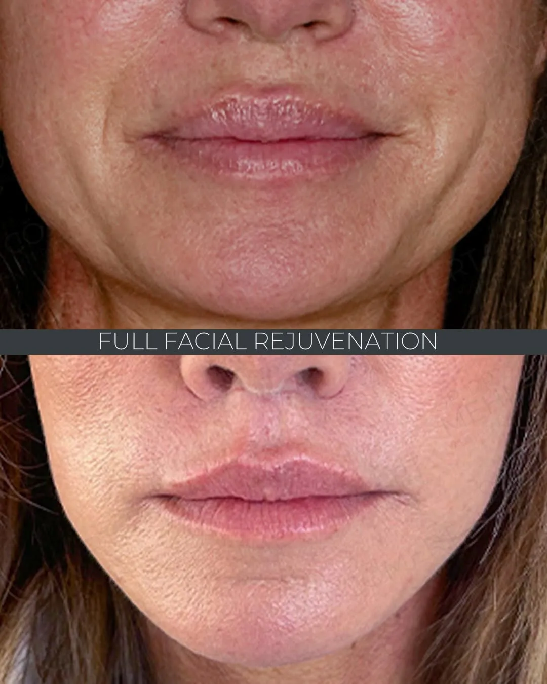 Before and after deep plane facelift — 55-year-old woman, frontal view, 7mo post-op by Dr. Mehmet Cömert