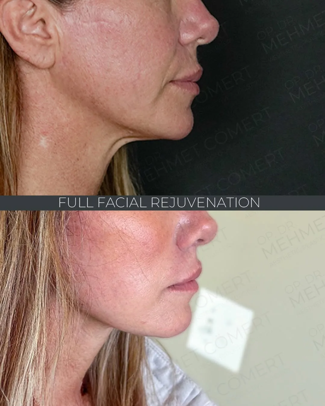 Before and after deep plane facelift — 45-year-old woman, left profile view, 6mo post-op by Dr. Mehmet Cömert