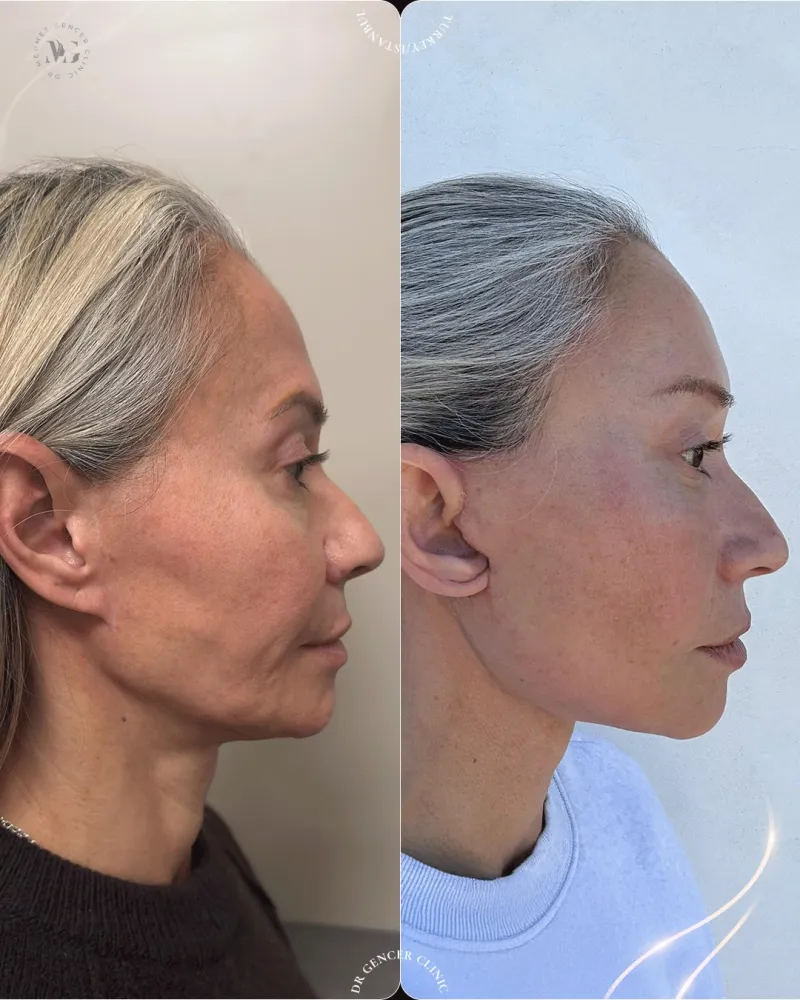 Before and after deep plane facelift, frontal view by Dr. Mehmet Gencer