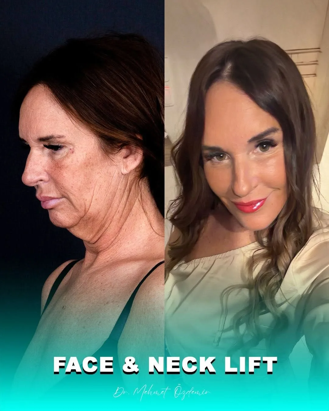 Before and after deep plane facelift — 55-year-old woman, three-quarter view, 12mo post-op by Dr. Mehmet Özdemir