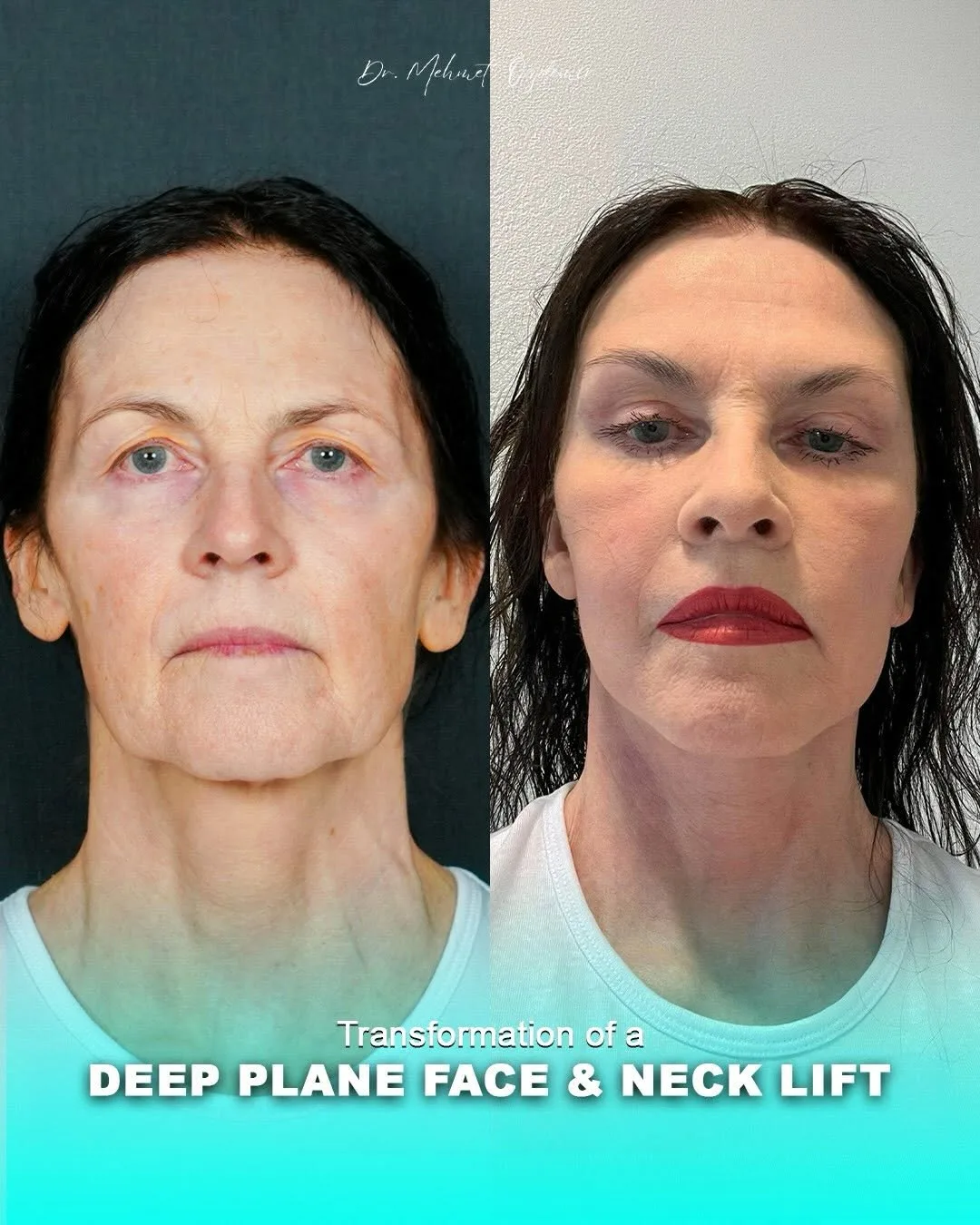 Before and after deep plane facelift — 55-year-old woman, frontal view, 7mo post-op by Dr. Mehmet Özdemir