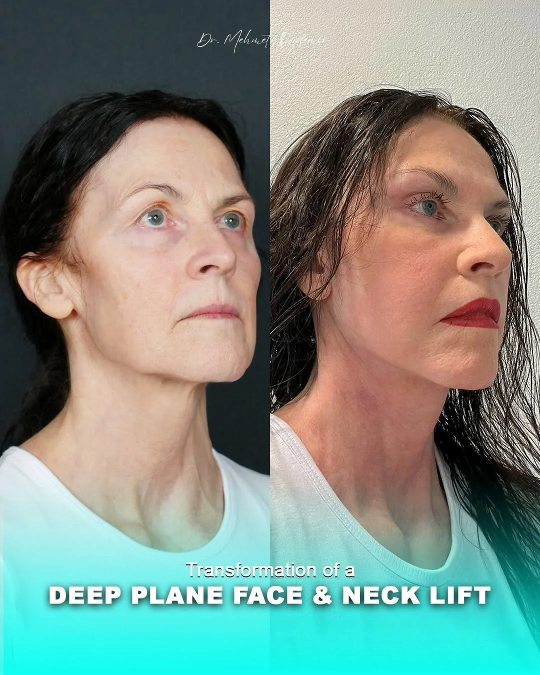 Before and after deep plane facelift — 55-year-old woman, right profile view, 6mo post-op by Dr. Mehmet Özdemir