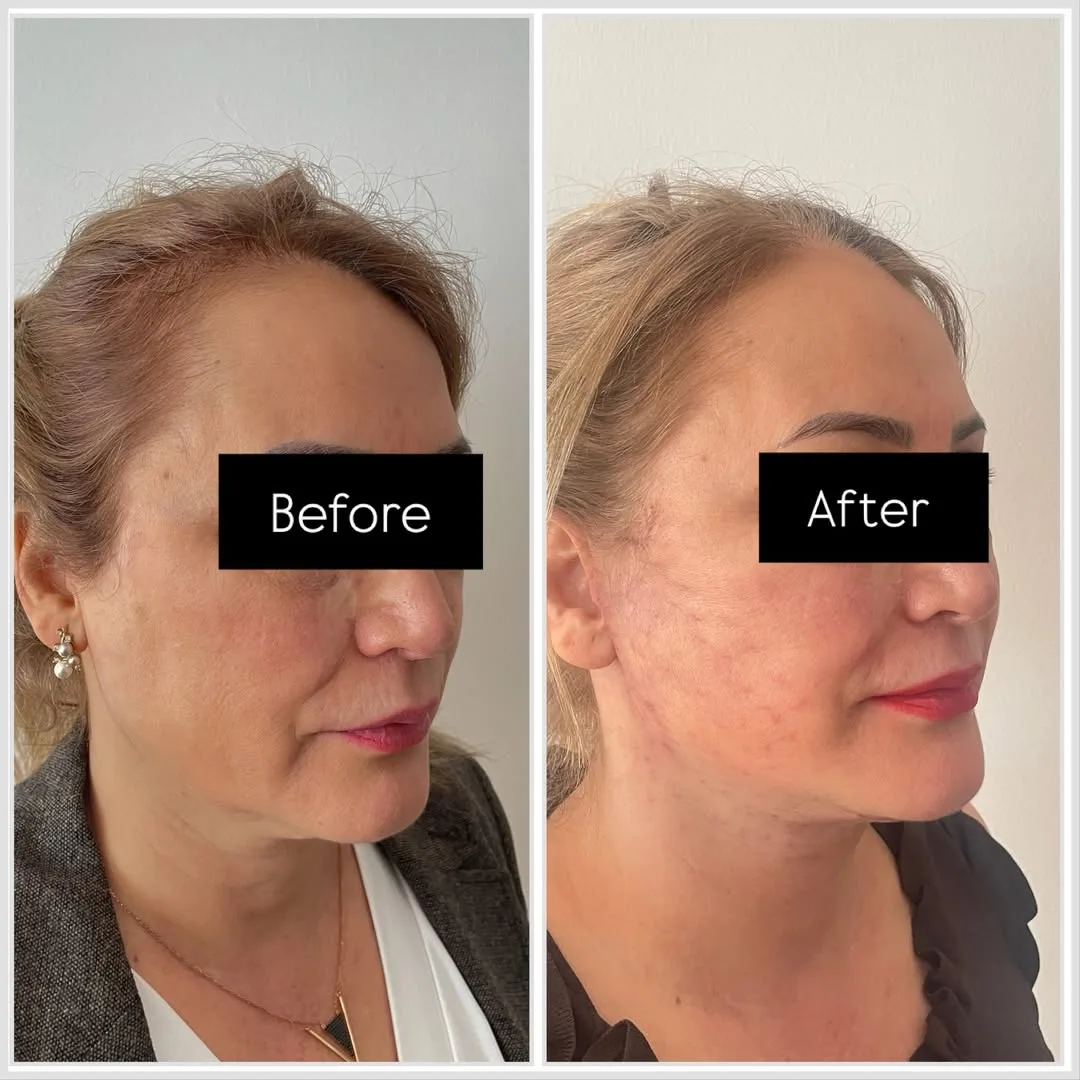 Before and after — Dr. Mehmet Saki