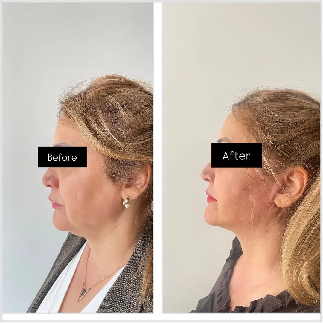 Before and after — Dr. Mehmet Saki