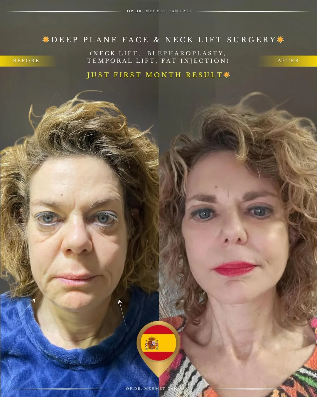 Before and after — Dr. Mehmet Saki