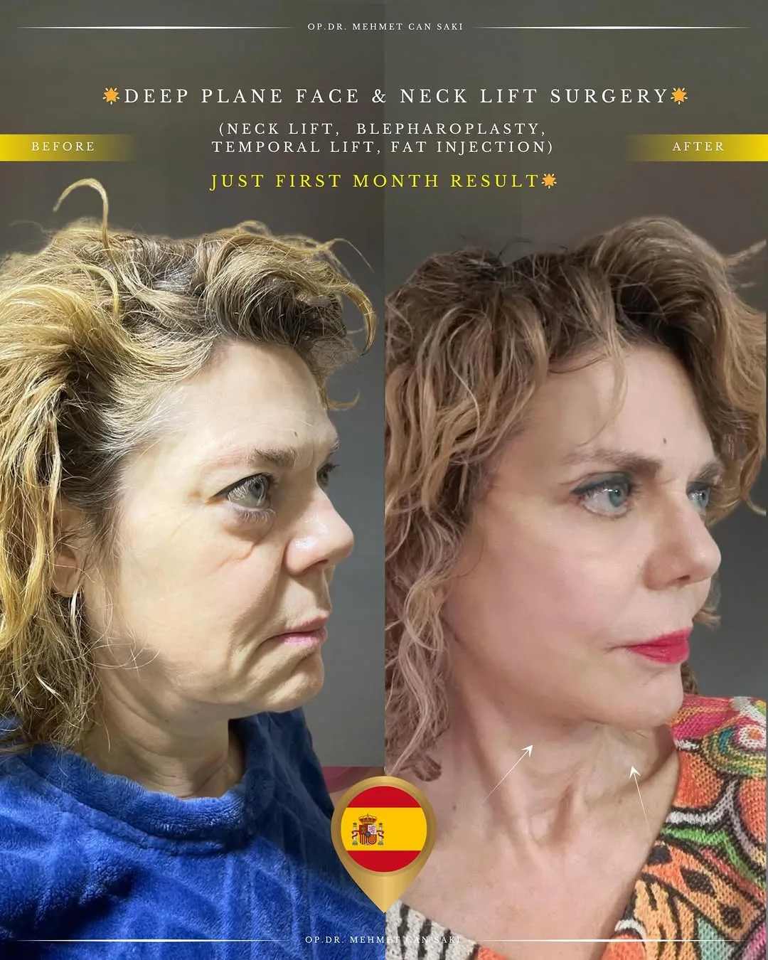 Before and after — Dr. Mehmet Saki
