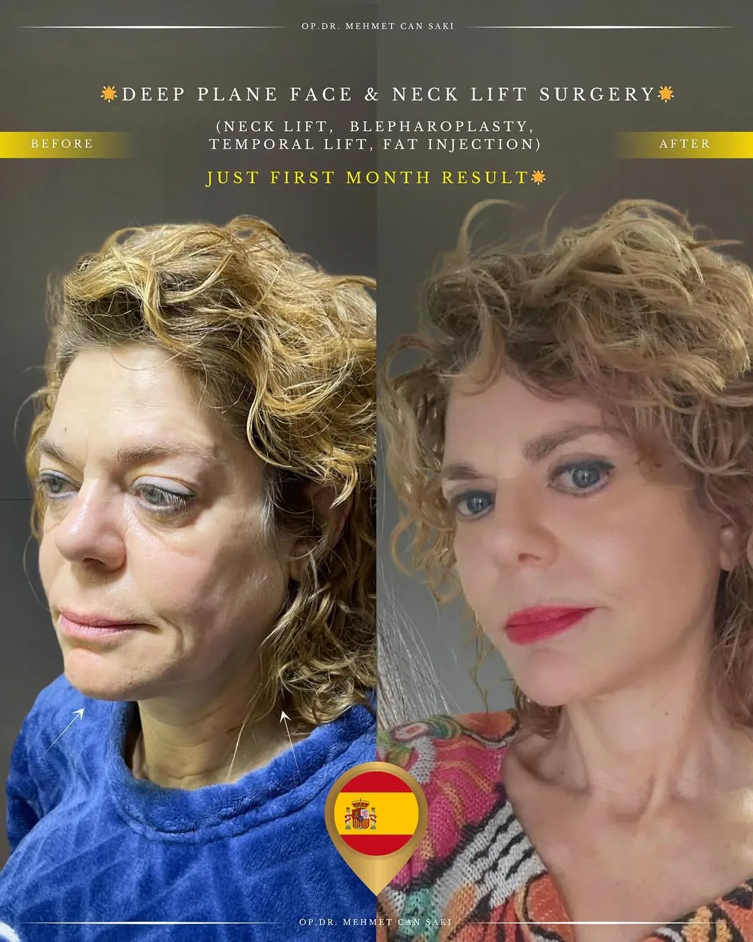 Before and after — Dr. Mehmet Saki