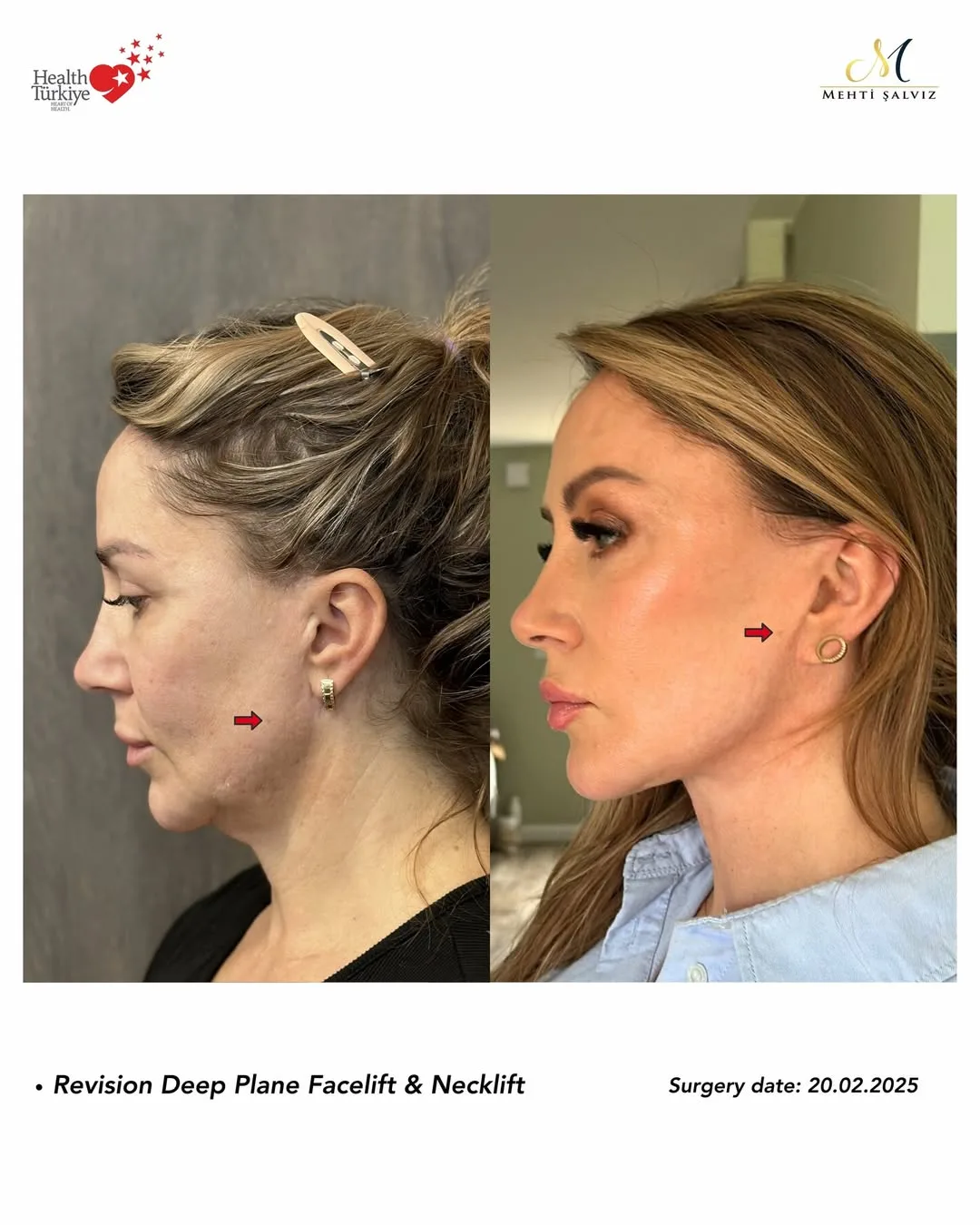 Before and after — Dr. Mehti Salviz