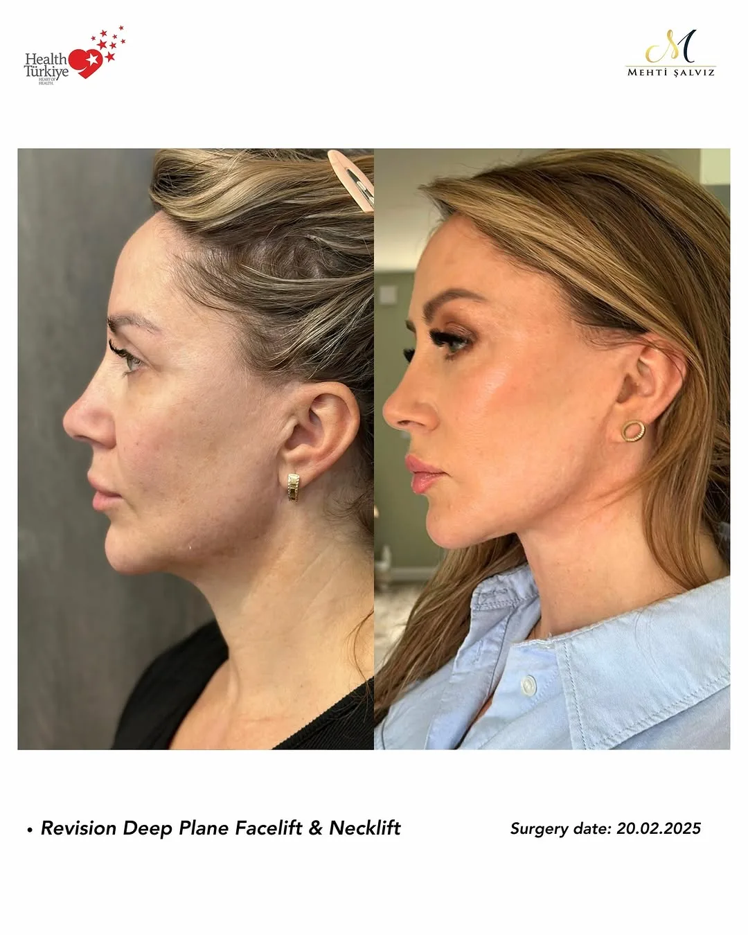 Before and after — Dr. Mehti Salviz