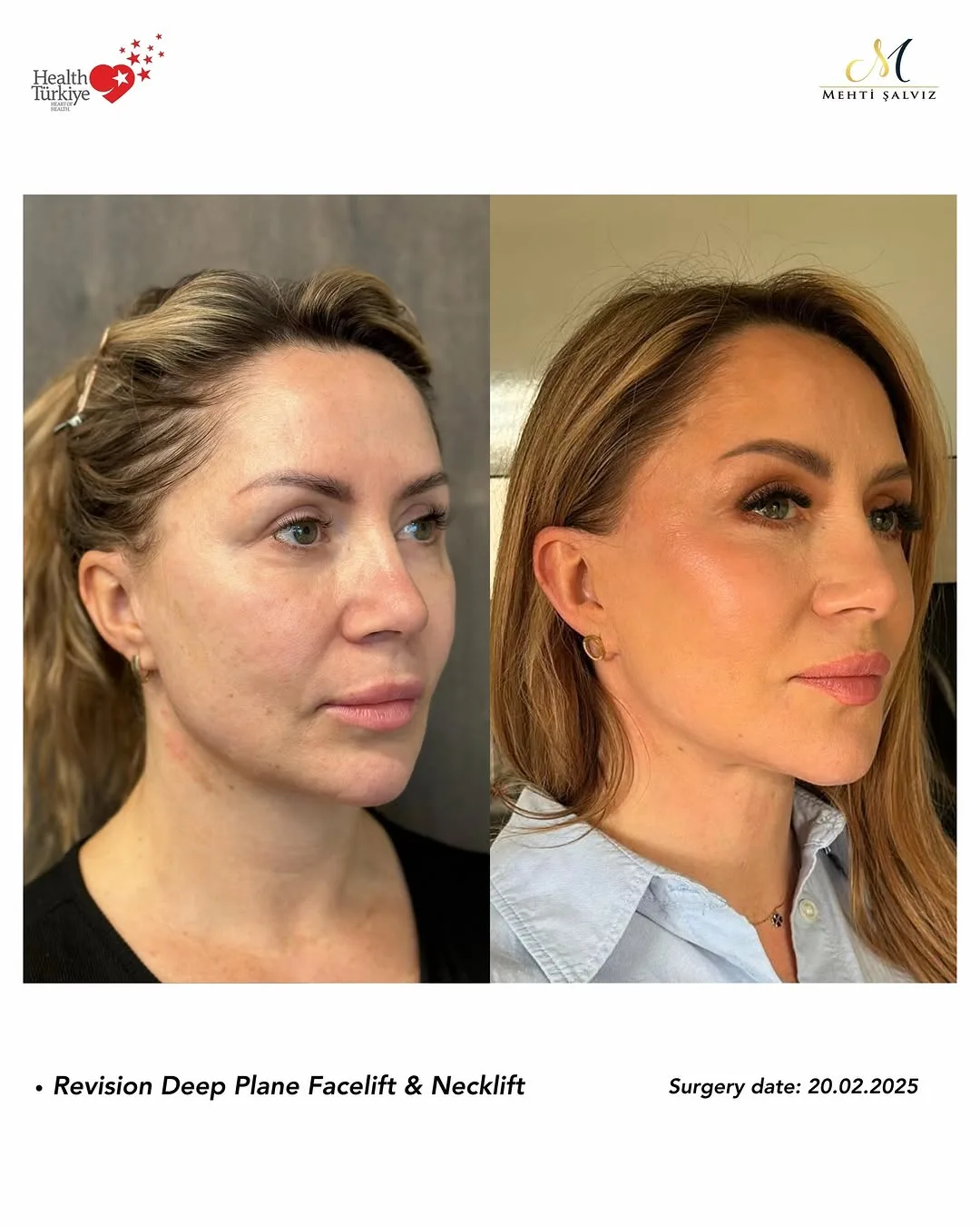 Before and after — Dr. Mehti Salviz