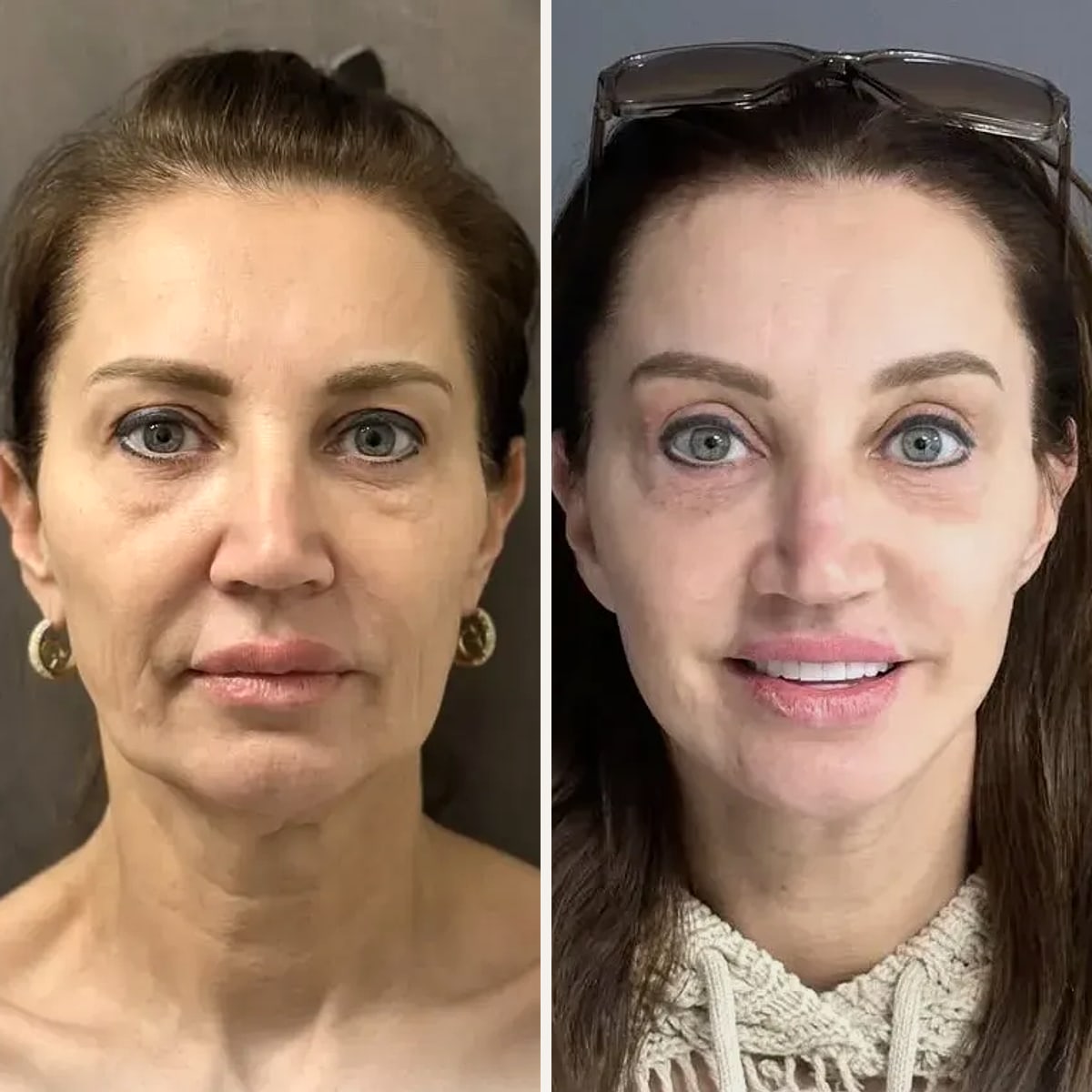 Before and after: Dr. Mehti Salviz