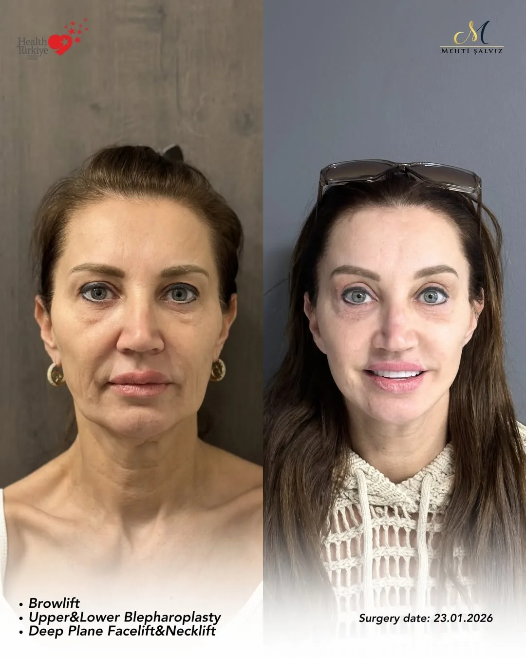 Before and after — Dr. Mehti Salviz