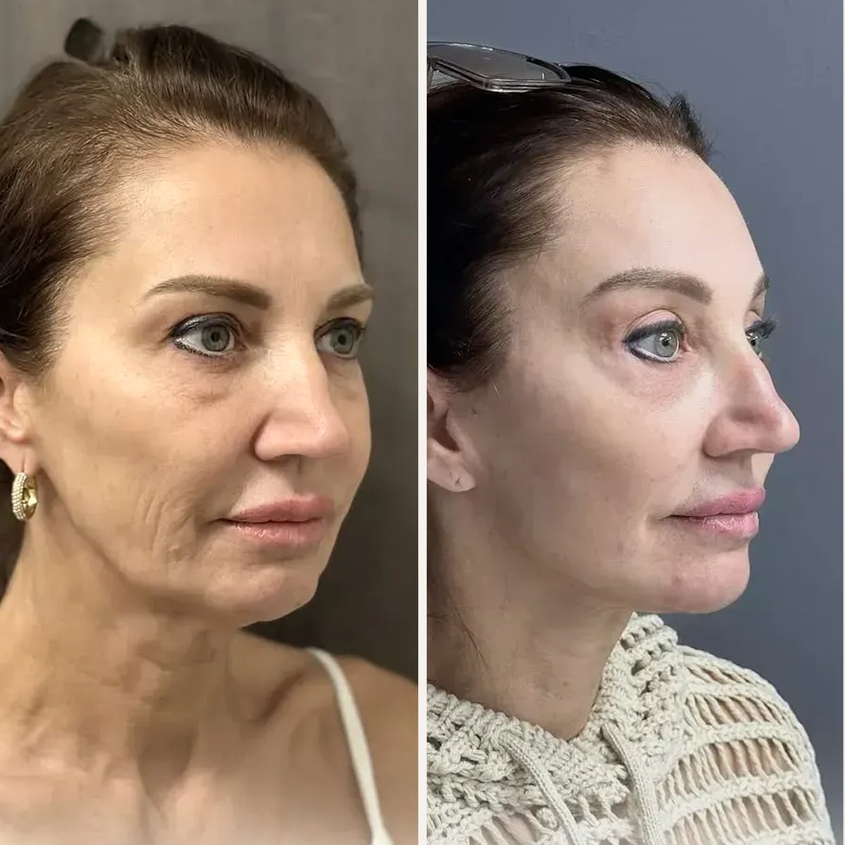 Before and after: Dr. Mehti Salviz