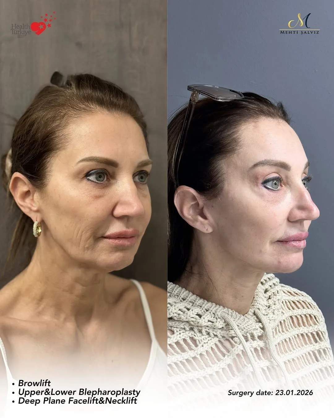 Before and after — Dr. Mehti Salviz