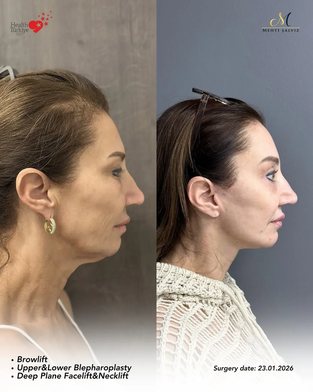Before and after — Dr. Mehti Salviz
