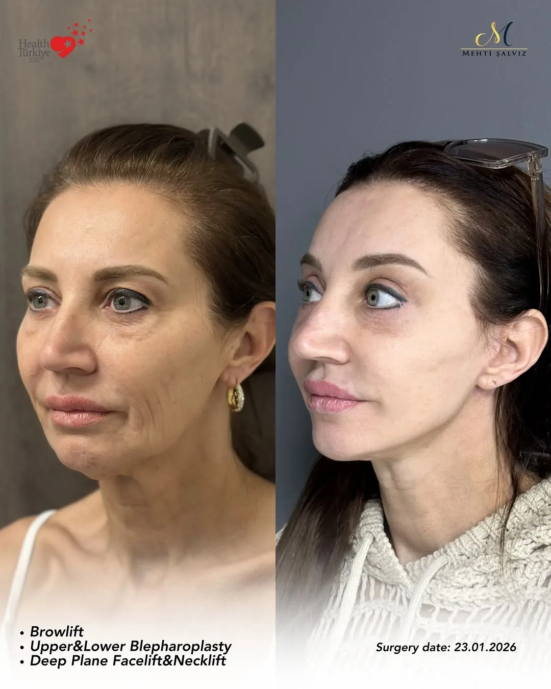 Before and after — Dr. Mehti Salviz