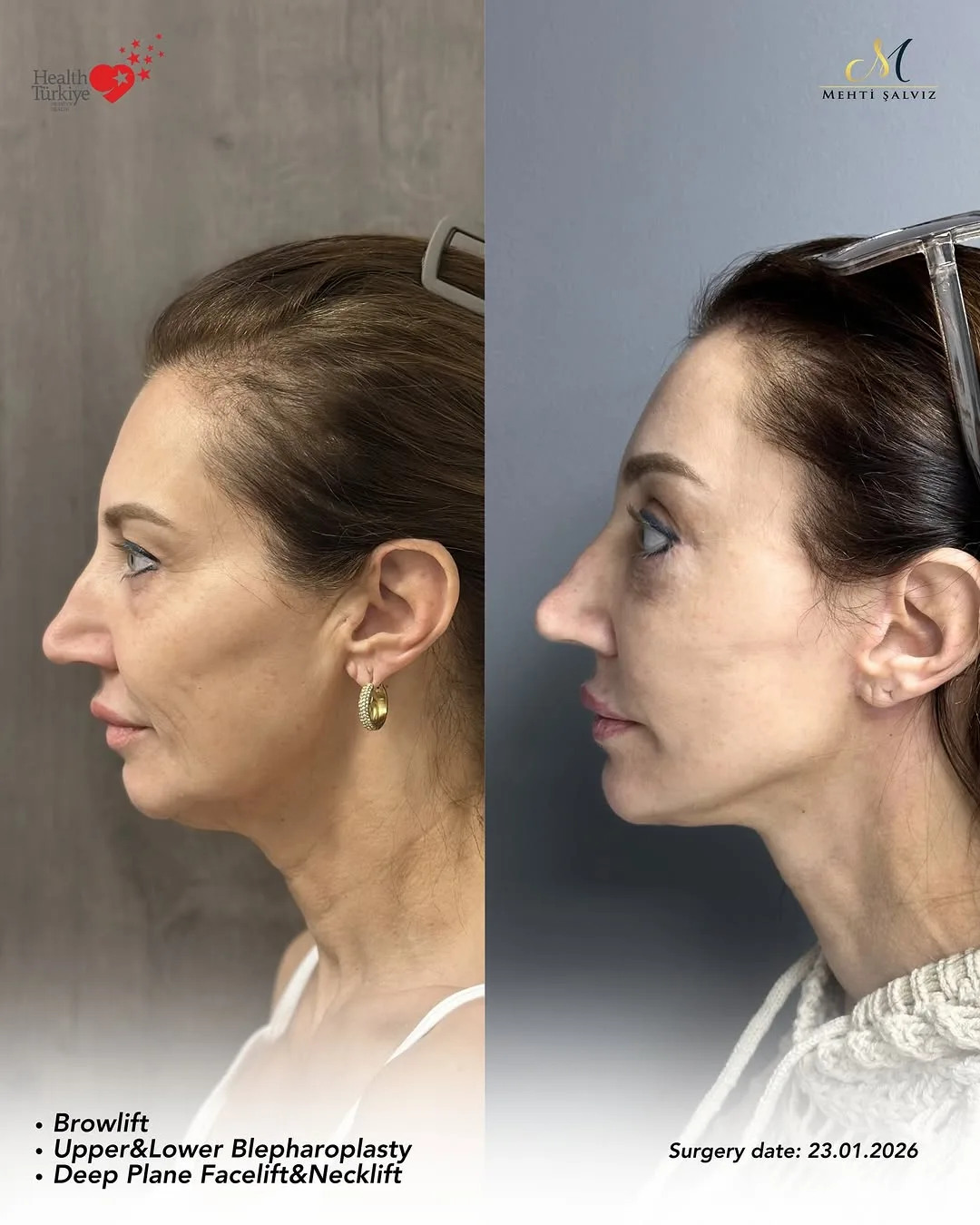 Before and after — Dr. Mehti Salviz