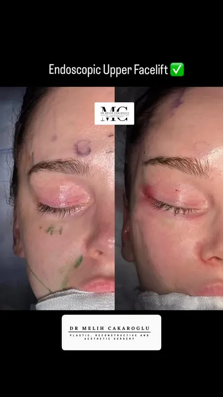 Before and after deep plane facelift — -1-year-old patient, frontal view by Dr. Melih Çakaroğlu