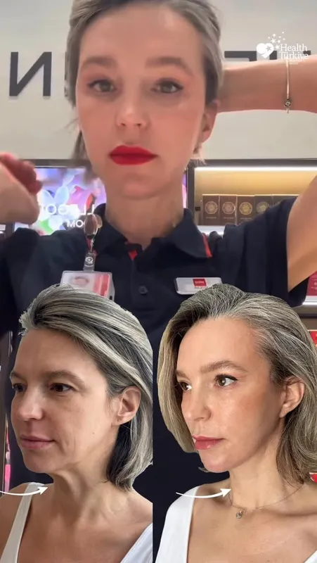 Before and after deep plane facelift — -1-year-old patient, frontal view by Dr. Melih Canlı
