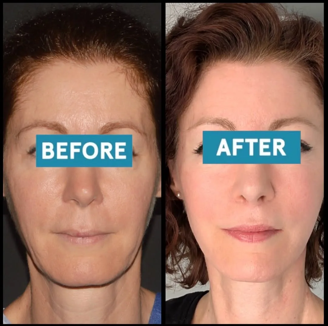 Before and after — Dr. Mert Canlı