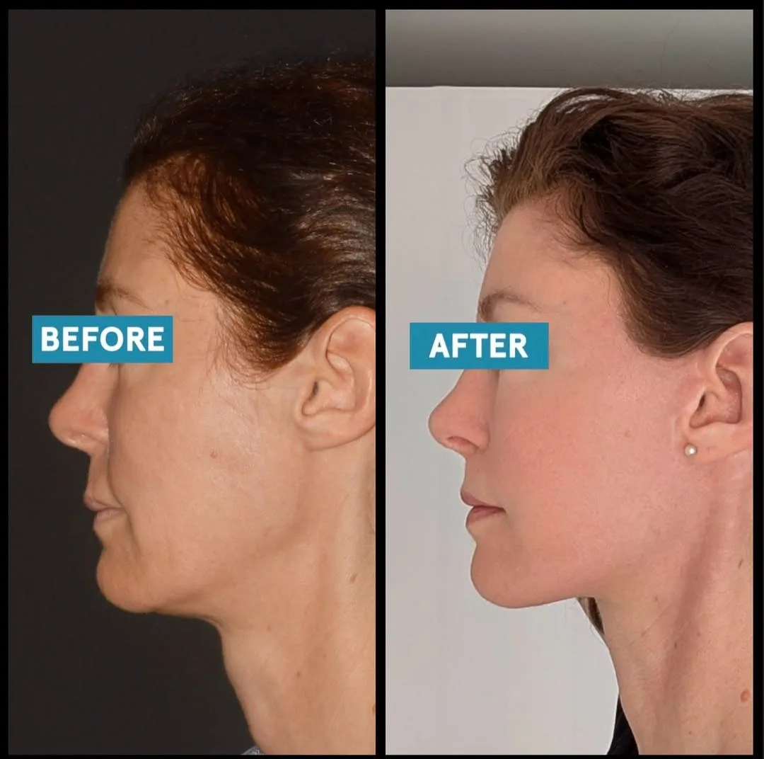 Before and after — Dr. Mert Canlı