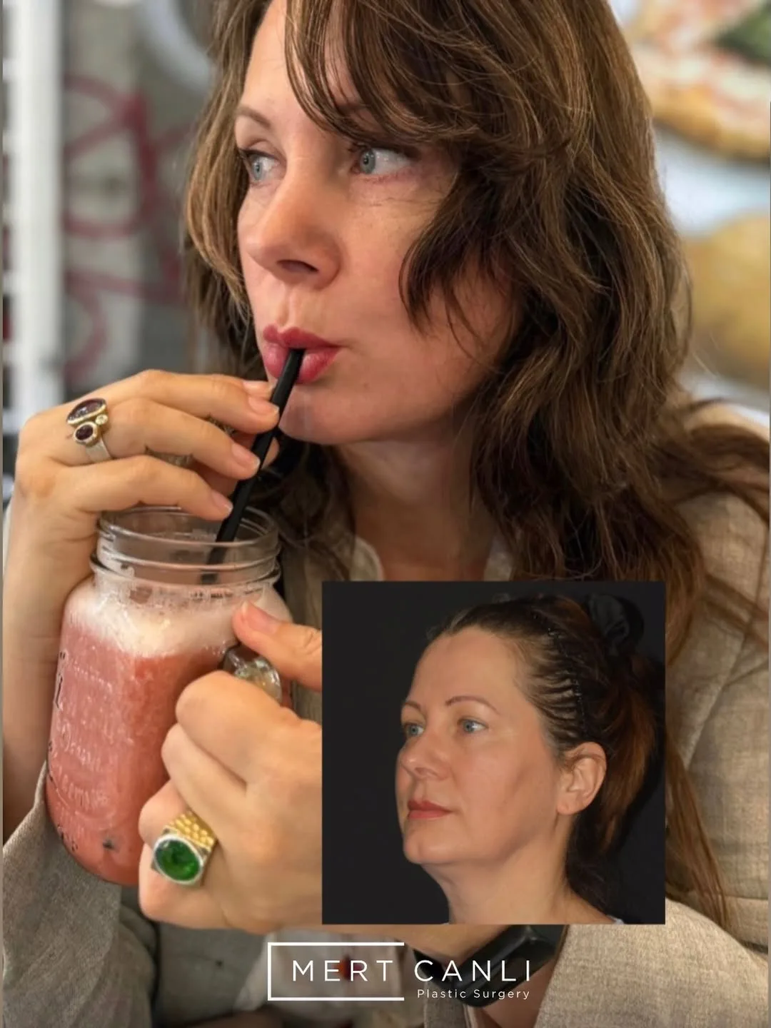Before and after — Dr. Mert Canlı