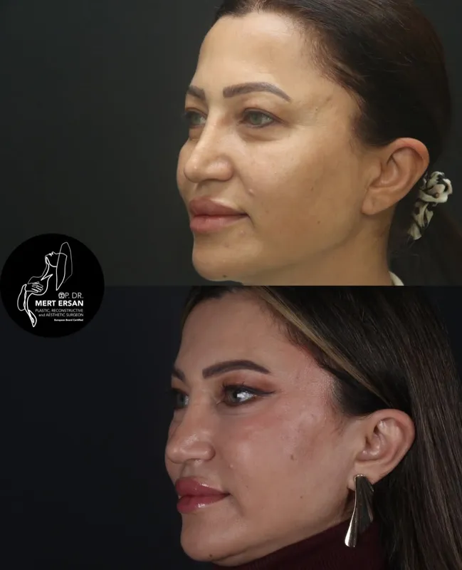 Before and after deep plane facelift, frontal view by Dr. Mert Ersan