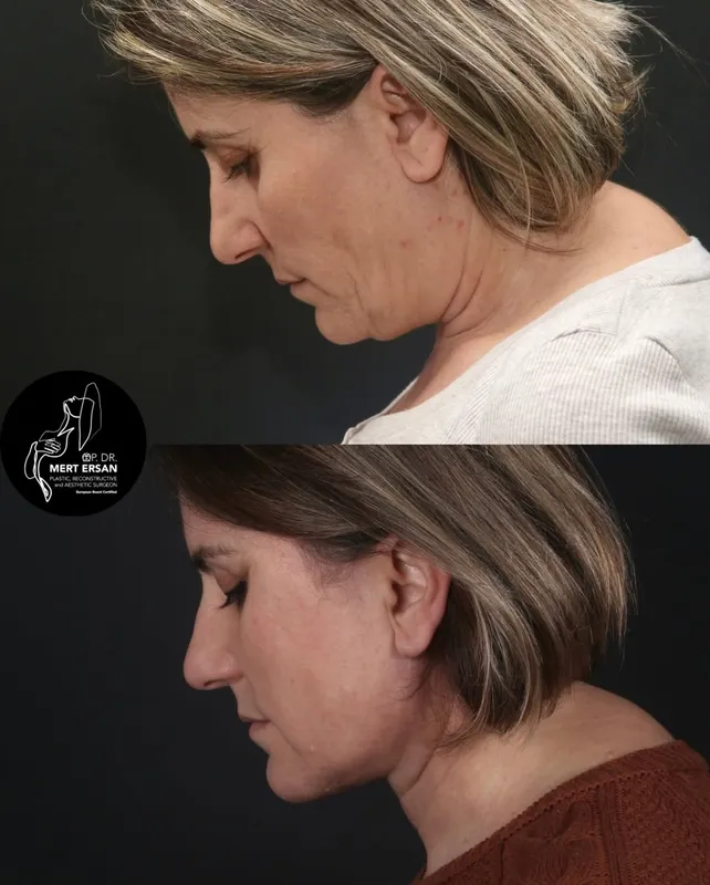 Before and after deep plane facelift, frontal view by Dr. Mert Ersan