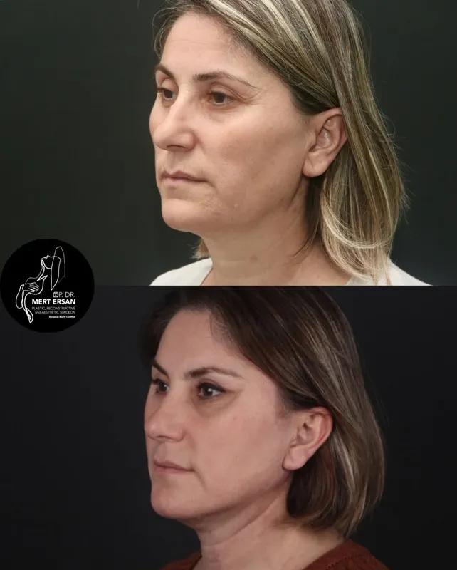 Before and after deep plane facelift, frontal view by Dr. Mert Ersan