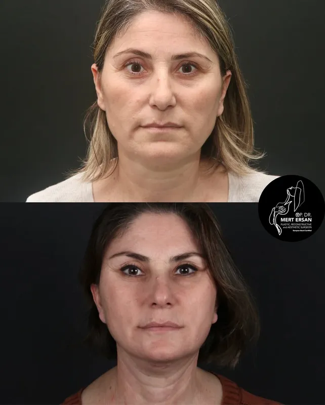 Before and after deep plane facelift, frontal view by Dr. Mert Ersan