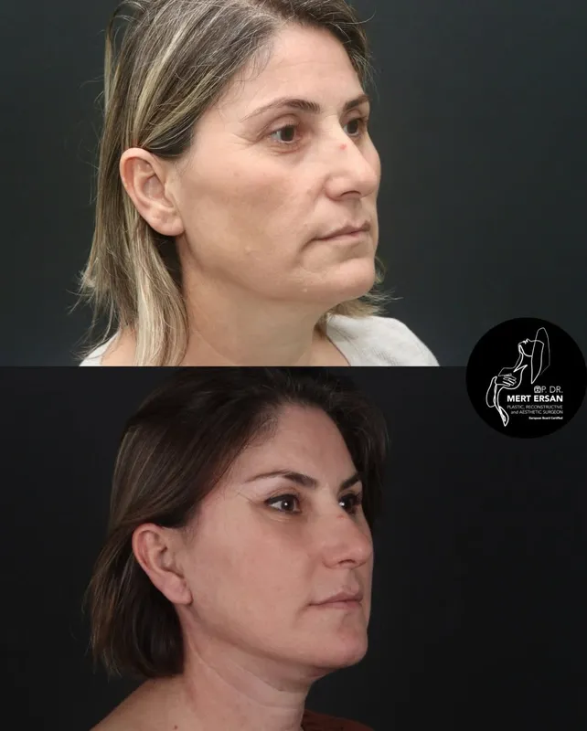 Before and after deep plane facelift, frontal view by Dr. Mert Ersan