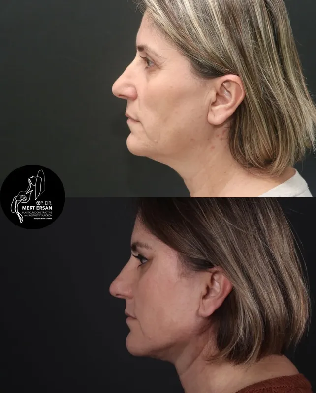 Before and after deep plane facelift, frontal view by Dr. Mert Ersan