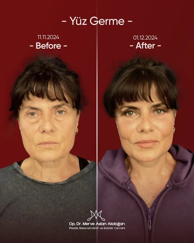 Before and after deep plane facelift — -1-year-old patient, frontal view by Dr. Merve Aslan Akdoğan