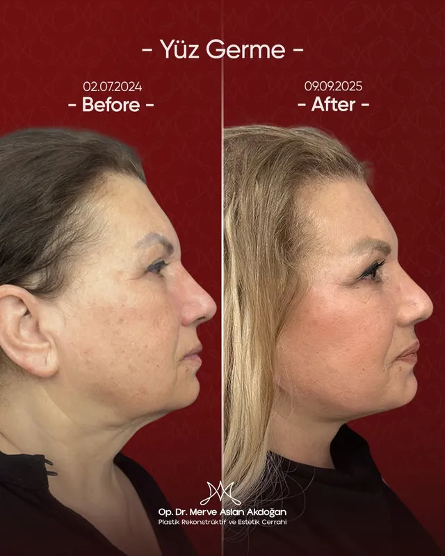 Before and after deep plane facelift — -1-year-old patient, frontal view by Dr. Merve Aslan Akdoğan