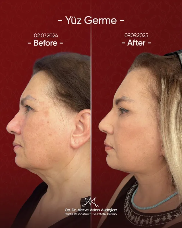 Before and after deep plane facelift — -1-year-old patient, frontal view by Dr. Merve Aslan Akdoğan