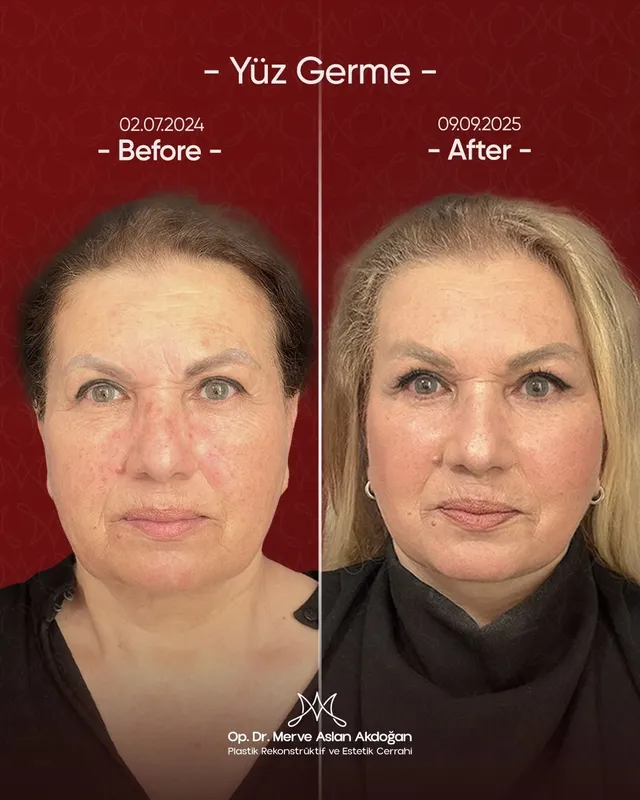 Before and after deep plane facelift — -1-year-old patient, frontal view by Dr. Merve Aslan Akdoğan