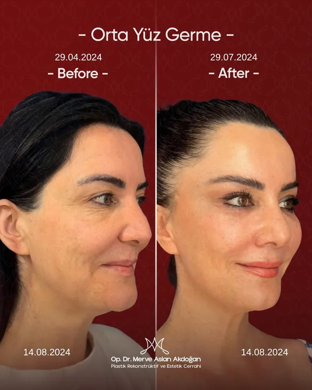 Before and after deep plane facelift — -1-year-old patient, frontal view by Dr. Merve Aslan Akdoğan