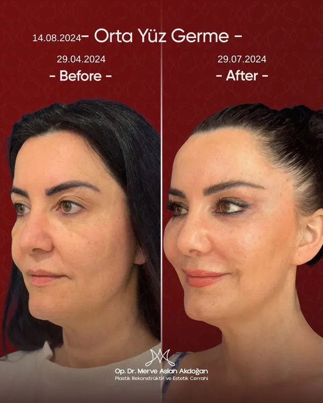 Before and after deep plane facelift — -1-year-old patient, frontal view by Dr. Merve Aslan Akdoğan
