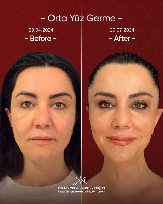 Before and after deep plane facelift — -1-year-old patient, frontal view by Dr. Merve Aslan Akdoğan