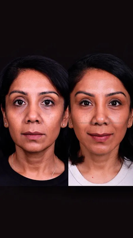 Before and after — Dr. Metin Kerem